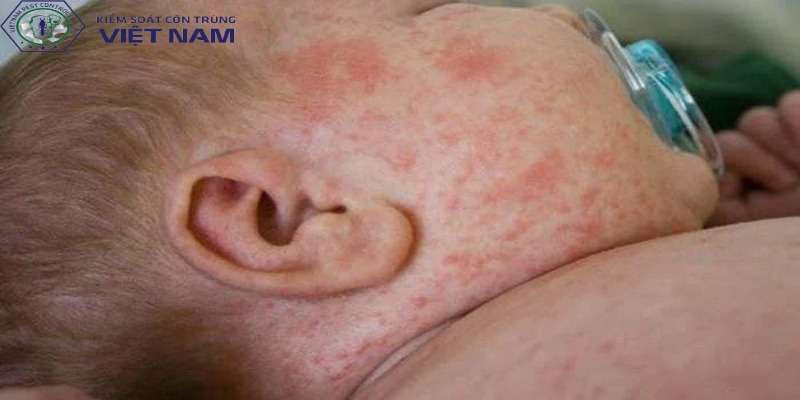 Sốt xuất huyết ở trẻ em